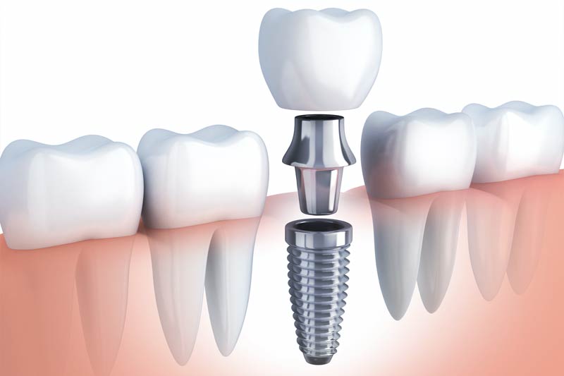 Implants Dentist in San Jose