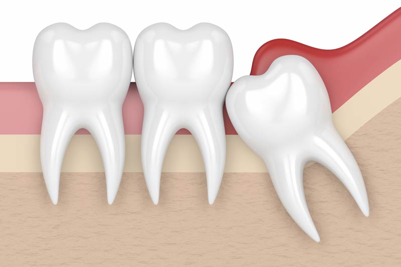 Wisdom Tooth Removal in San Jose